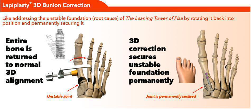 Lapiplasty® 3D Bunion Correction